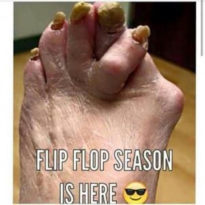 flip flops ugly feet